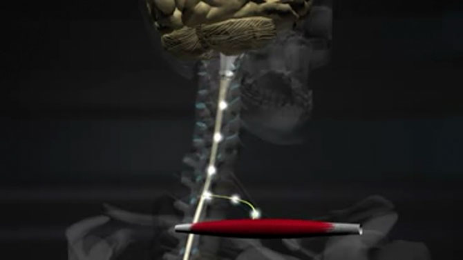 Informationsvideo zum Thema 'Rückenschmerzen'